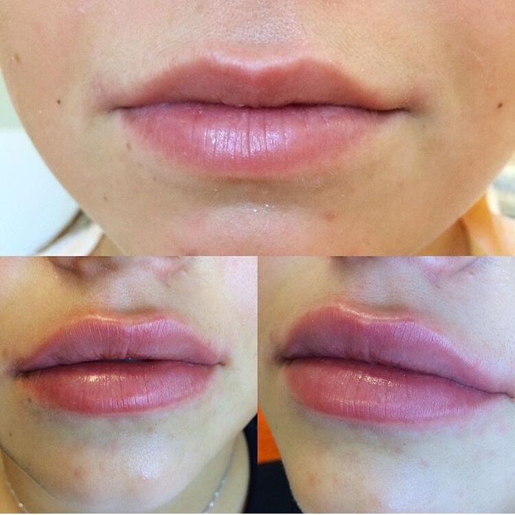 Otesaly®. lip contour & augmentation